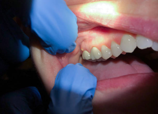 Best Emergency Denture Repair in Gardere, LA